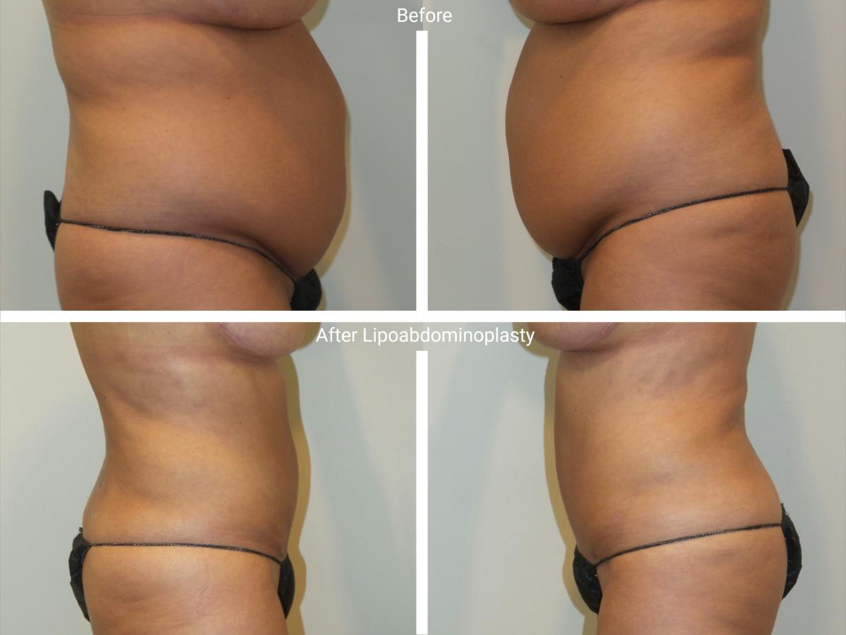 Lipoabdominoplasty Before and After Photos