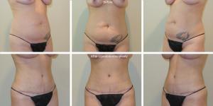 Lipoabdominoplasty Before and After Photos