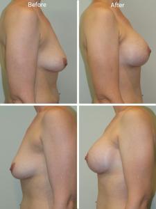Breast Augmentation Mastopexy Before and After Photos