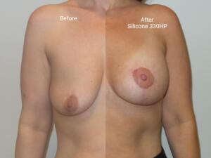 Breast Augmentation Mastopexy Before and After Photos