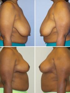 Breast reduction before and after photos