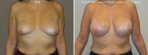 Breast reconstruction photos
