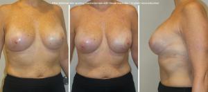 Breast reconstruction photos