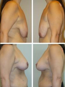Mastopexy Breast Lift Before and After Photos