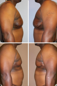 Gynecomastia Before and After Photo
